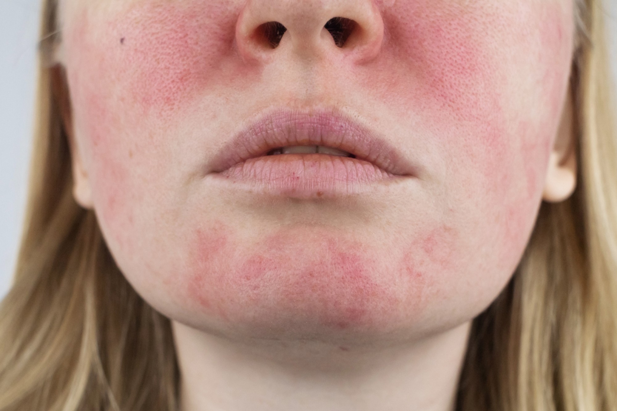 Rosacea Treatment for Control & Comfort