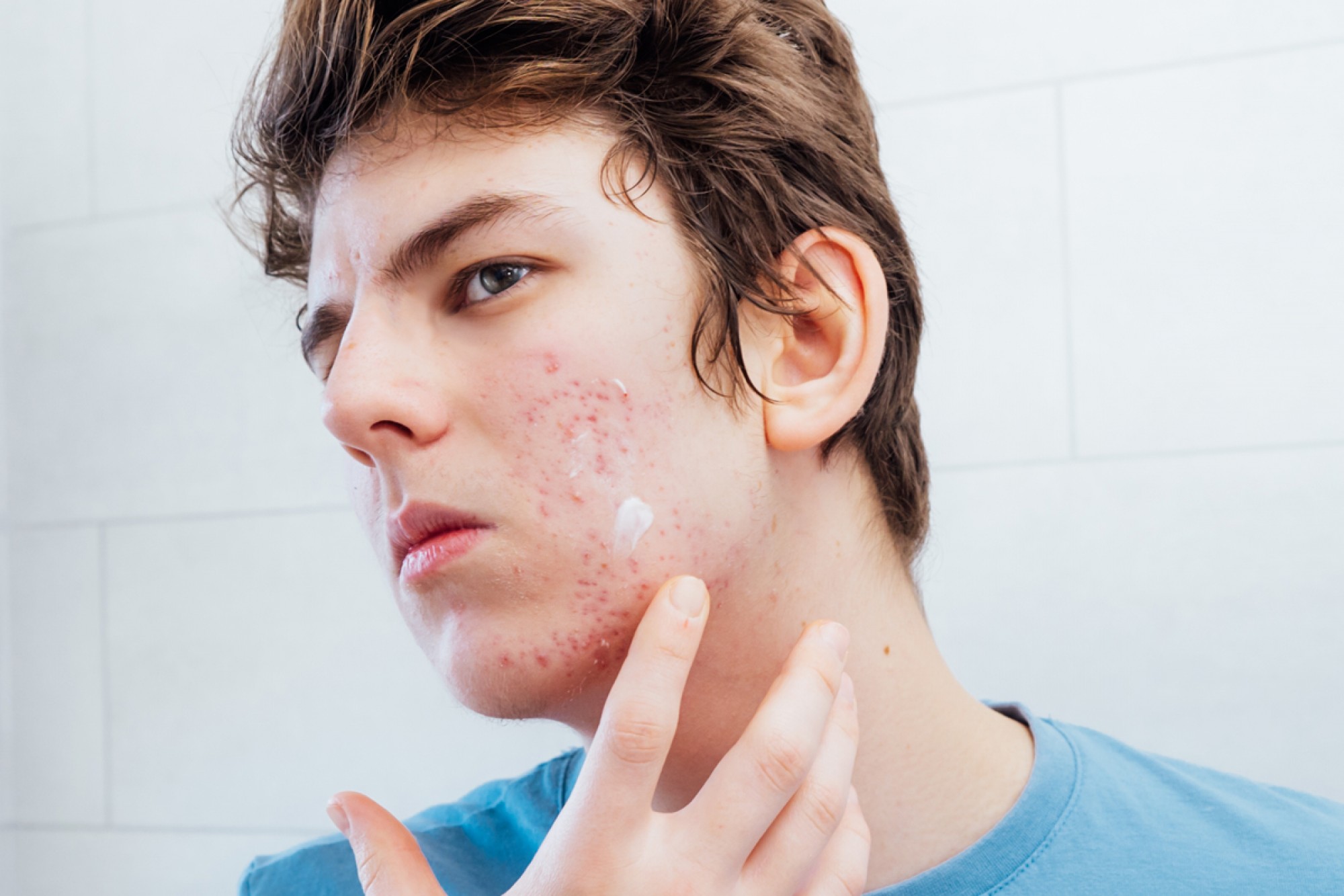 Acne & Acne Scarring Care