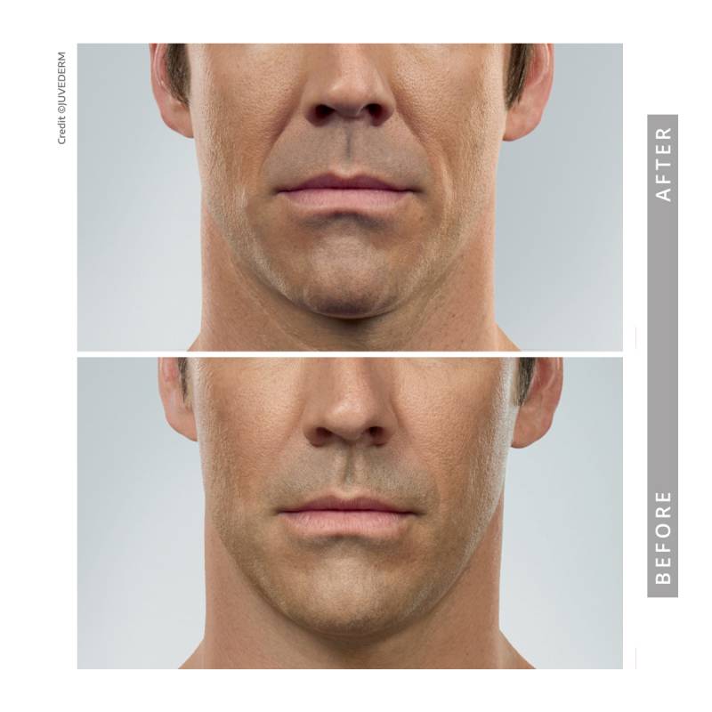 Closeup on a front view of a man’s mouth. He has deep folds around his mouth. After the Juvederm treatment the fold have reduced in appearance 