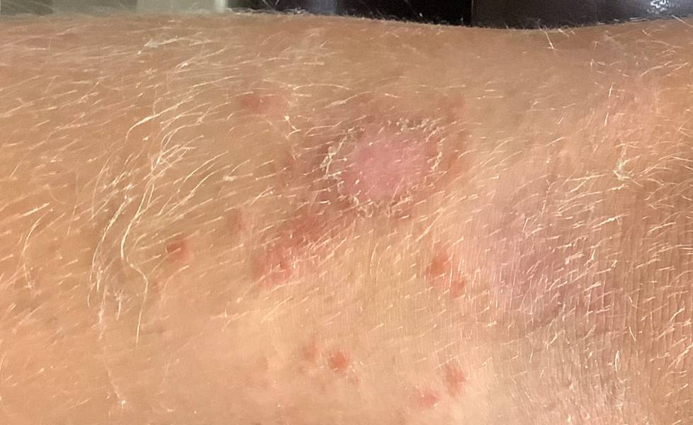 Impetigo in Children and Adults: A Dermatologist’s Guide to Relief and Recovery Impetigo in Children and Adults: A Dermatologist’s Guide to Relief and Recovery