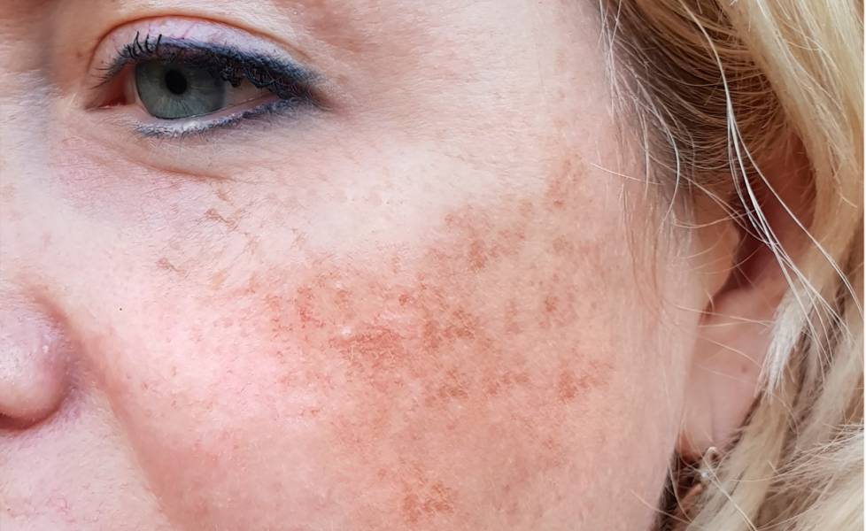 If You Are Suffering from MELASMA this Article is a Must Read.