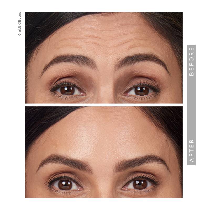 Closeup on a before and after comparative images on a woman. Both pictures frames the eyes and forehead. The eyebrows are lifted in both images. In the before image several strong wrinkle lines appearing on his forehead. In the after image those lines and wrinkles disappeared.