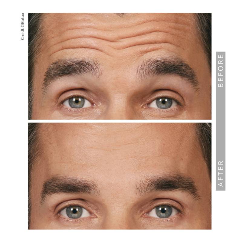 Closeup on a before and after comparative images on a man. Both pictures frames the eyes and forehead. The eyebrows are lifted in both images. In the before image several strong wrinkle lines appearing on his forehead. In the after image those lines and wrinkles disappeared.