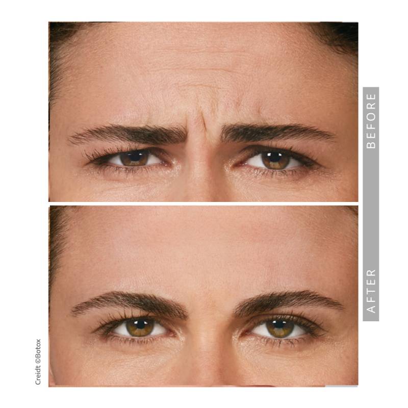 Closeup on a before and after comparative images on a woman. Both pictures frames the eyes of woman. She is frowning in both images. In the before image several strong wrinkle lines appearing between her eyes and  a few fine lines on her forehead. In the after image those lines and wrinkles disappeared.