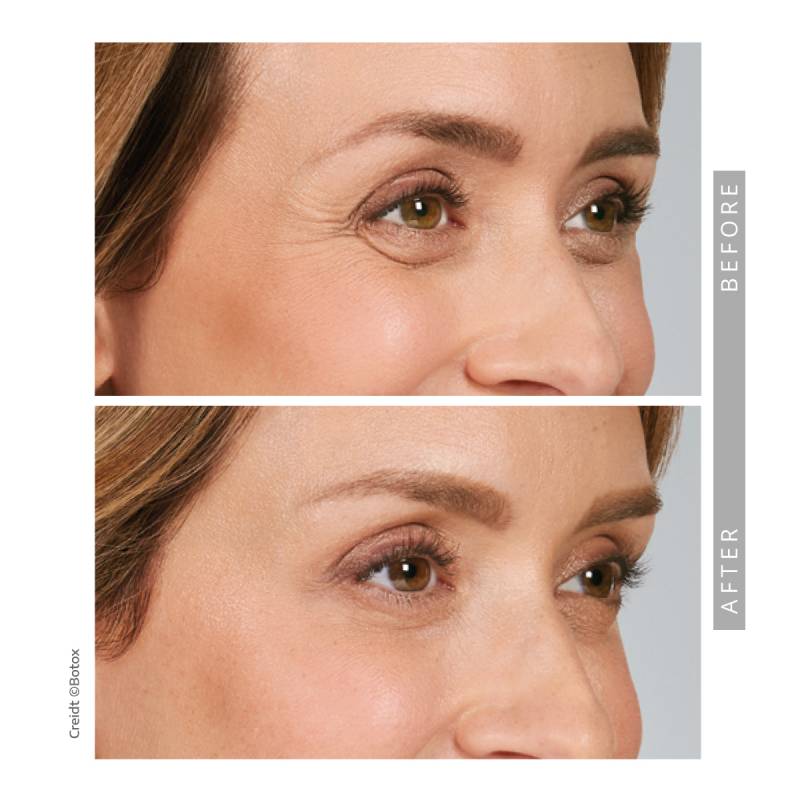 Closeup on a before and after comparative images on a woman. Both pictures frames the eyes of woman, her face is 3/4 angle. She is smiling in both images. In the before image several strong wrinkle lines appearing next to her eyes, these are called crows feet. In the after image those lines and wrinkles disappeared.