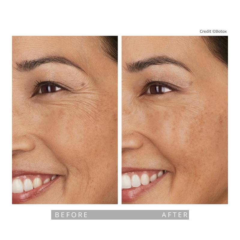 Closeup on a before and after comparative images on a woman. Both pictures frames the eyes of woman, her face is 3/4 angle. She is smiling in both images. In the before image several strong wrinkle lines appearing next to her eyes, these are called crows feet. In the after image those lines and wrinkles disappeared.