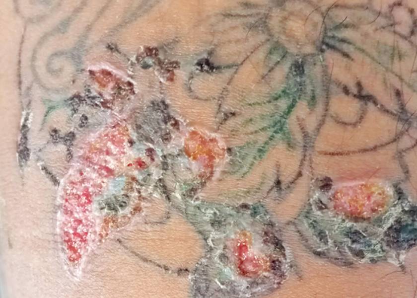 7 SKIN REACTIONS TO TATTOOS