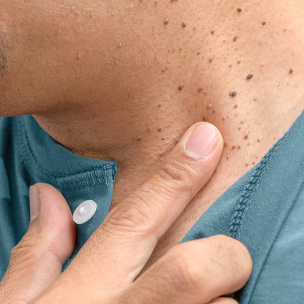 You're It! What Are Skin Tags?