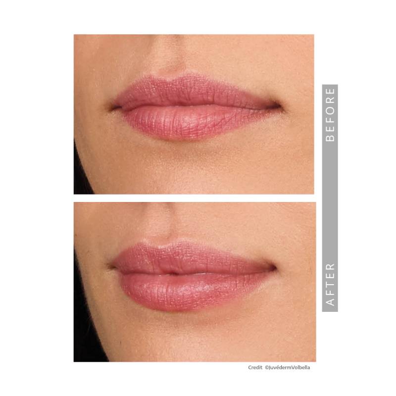 Close up on the lips of a woman before an after juvederm injections, her lips a fuller in the afterpicture