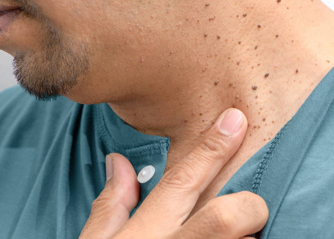 You're It! What Are Skin Tags?