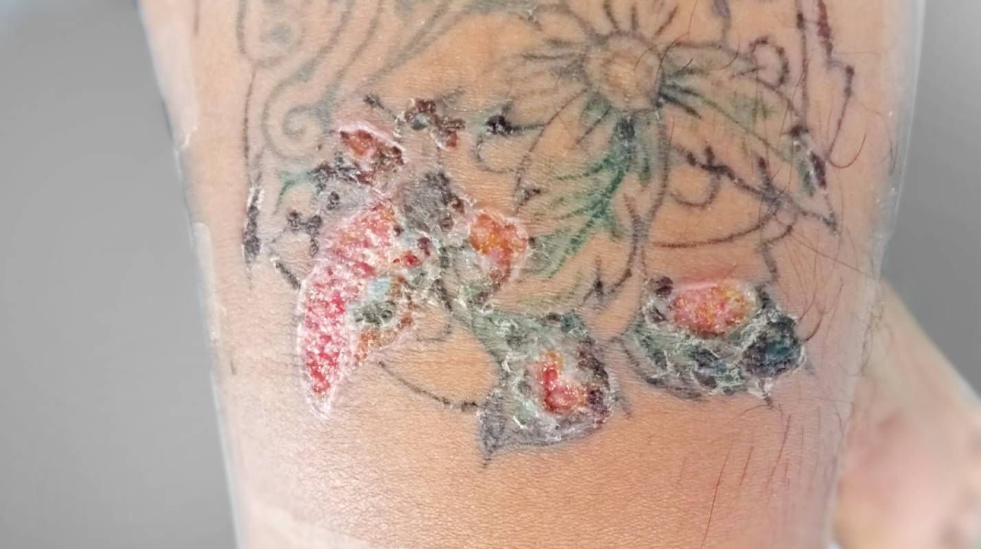 Tattoo Infections Symptoms Treatment  Legal Options  Fort Worth TX   Stephens Law Firm PLLC