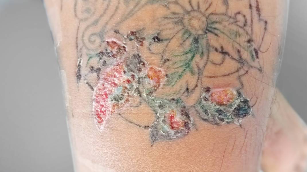 Infected Tattoo: The Signs Of Infection & How To Heal