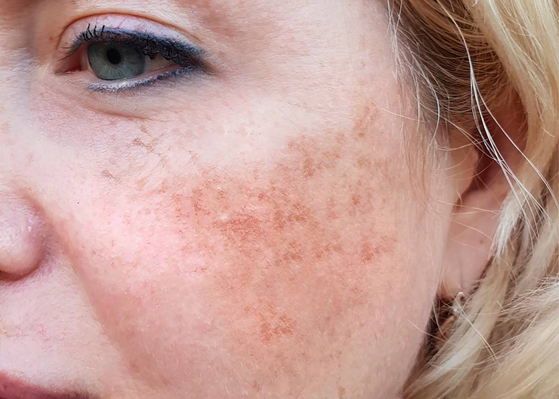 If You Are Suffering from MELASMA this Article is a Must Read