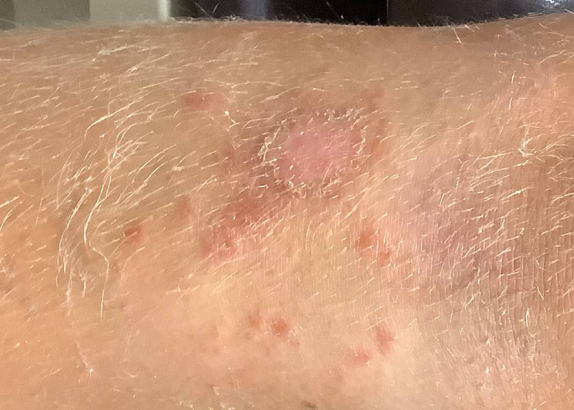 Impetigo in Children and Adults: A Dermatologist’s Guide to Relief and Recovery Impetigo in Children and Adults: A Dermatologist’s Guide to Relief and Recovery