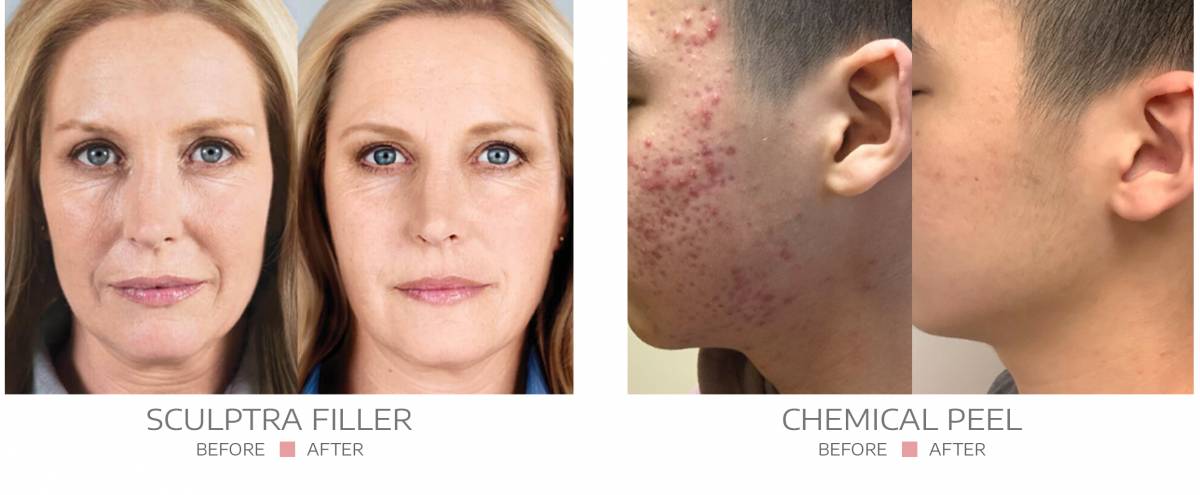 Before and after images showing rejuvenated, healthy skin, highlighting treatment benefits at Springs Dermatology MD.