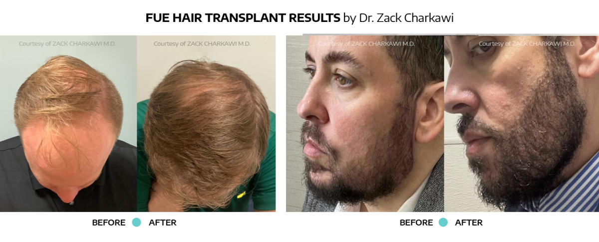 Before and after transformation of a patient with hair loss, showcasing successful hair transplant results at Springs Dermatology MD.