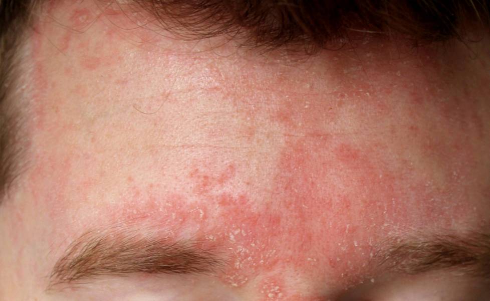 Seborrheic Dermatitis on the Face — Causes, Symptoms & What You Can Do