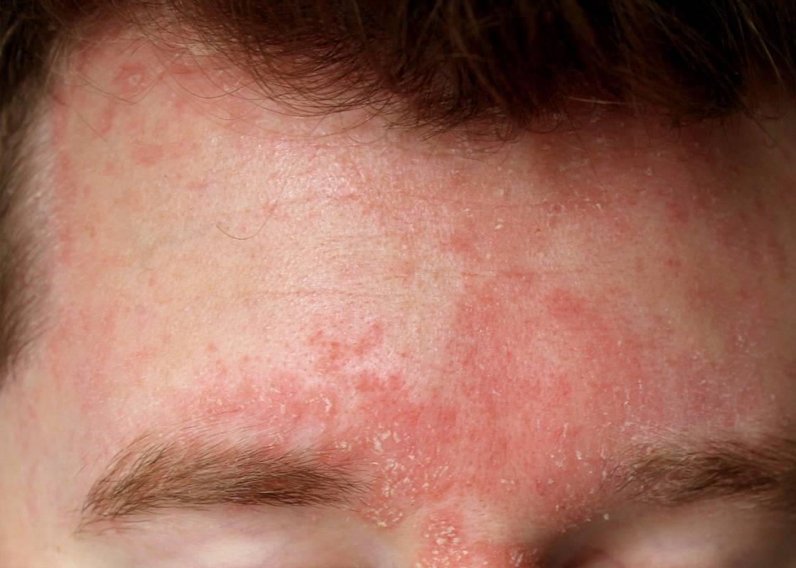 Seborrheic Dermatitis on the Face — Causes, Symptoms & What You Can Do