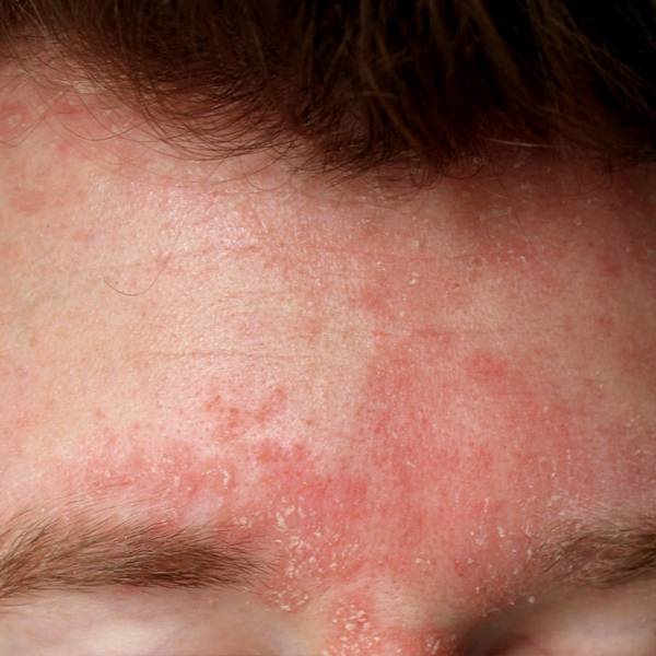 Seborrheic Dermatitis on the Face — Causes, Symptoms & What You Can Do