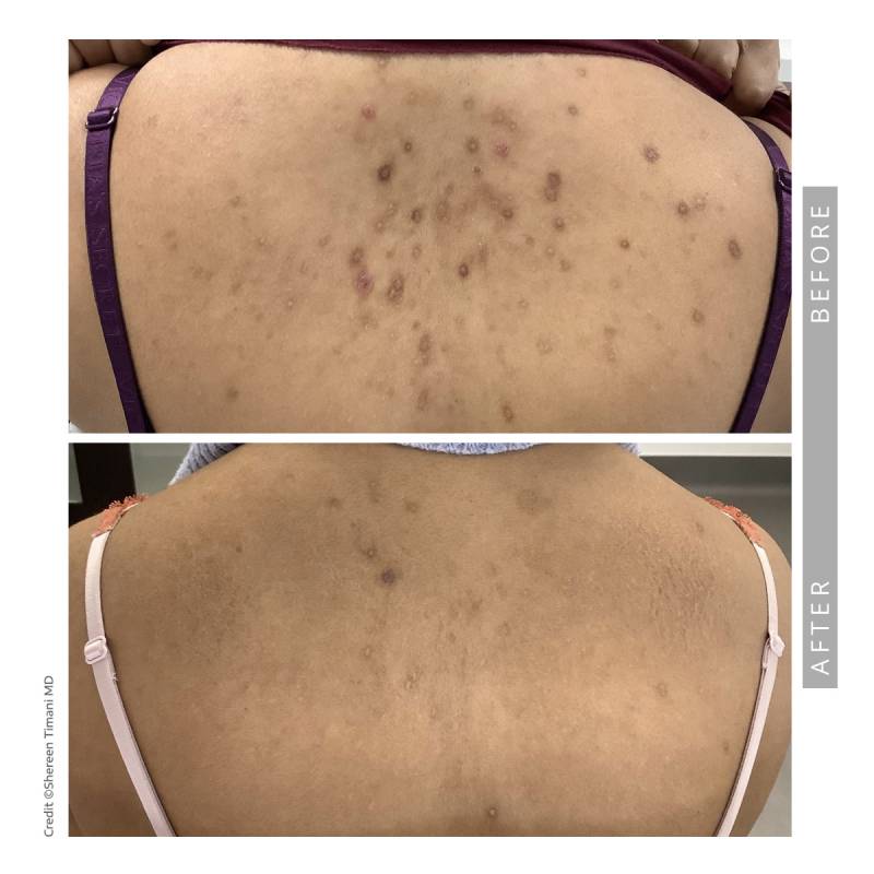 Closeup on a before and after comparative images. Both pictures frames the upper back of a woman. In the before image we can see acne scars and dark skin patches due to the acne. In the after image her skin has cleared up.