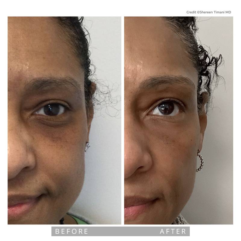 Closeup on a before and after comparative images. Both pictures frames the half of  the face of mature woman with dark skin tone. In the before image we can see dark circles around her eyes. In the after image we can see the disappearance of those dark circles under her eyes.