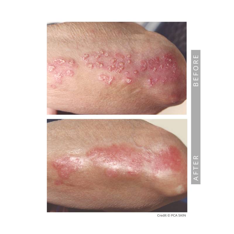 Closeup on a before and after comparative images. Both pictures frames an arm. In the before image we can the patient suffering from Psoriasis . In the after image We can see a significant reduction of Psoriasis.