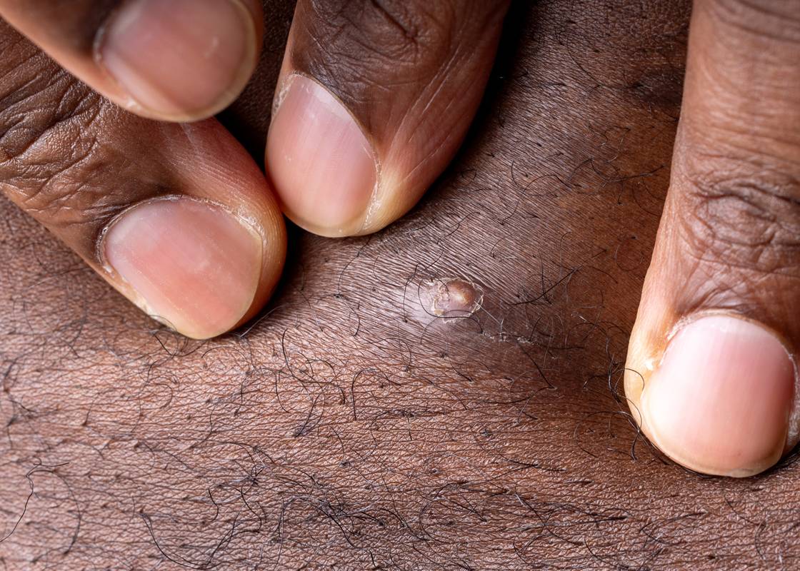 Ingrown Hairs: Causes, Treatment, Prevention, and When to See a Dermatologist