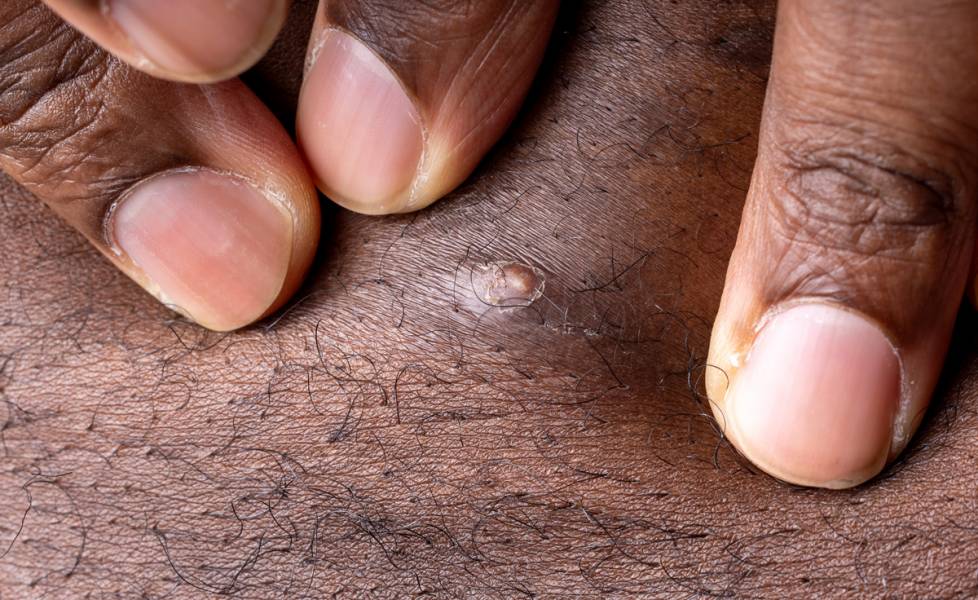 Ingrown Hairs: Causes, Treatment, Prevention, and When to See a Dermatologist
