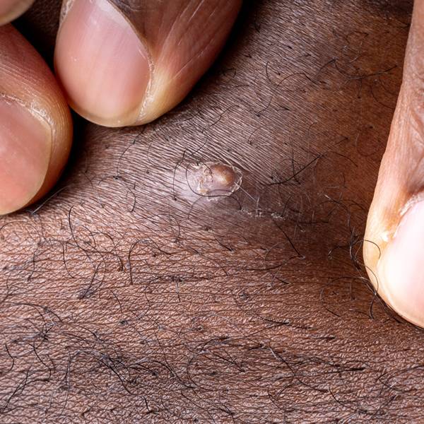 Ingrown Hairs: Causes, Treatment, Prevention, and When to See a Dermatologist