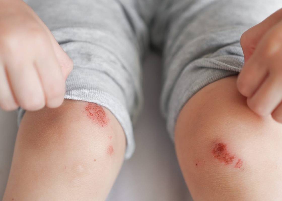 Impetigo in Children and Adults: A Dermatologist’s Guide to Relief and Recovery Impetigo in Children and Adults: A Dermatologist’s Guide to Relief and Recovery
