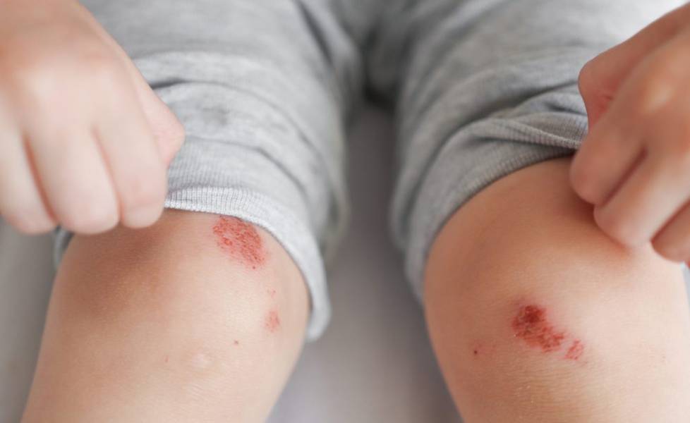 Impetigo in Children and Adults: A Dermatologist’s Guide to Relief and Recovery Impetigo in Children and Adults: A Dermatologist’s Guide to Relief and Recovery