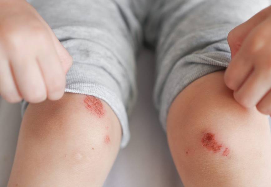 Impetigo in Children and Adults: A Dermatologist’s Guide to Relief and Recovery