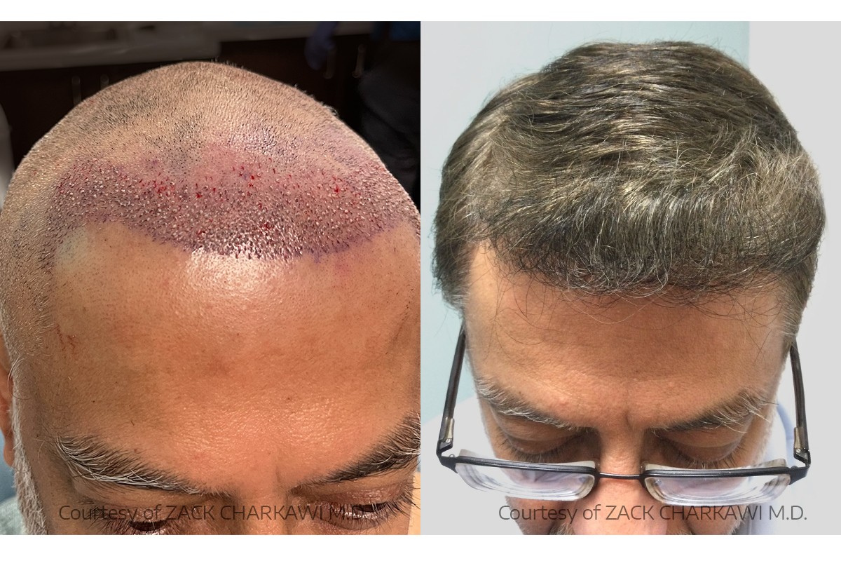 Before-and-after FUE hairline—post-op grafts vs regrowth