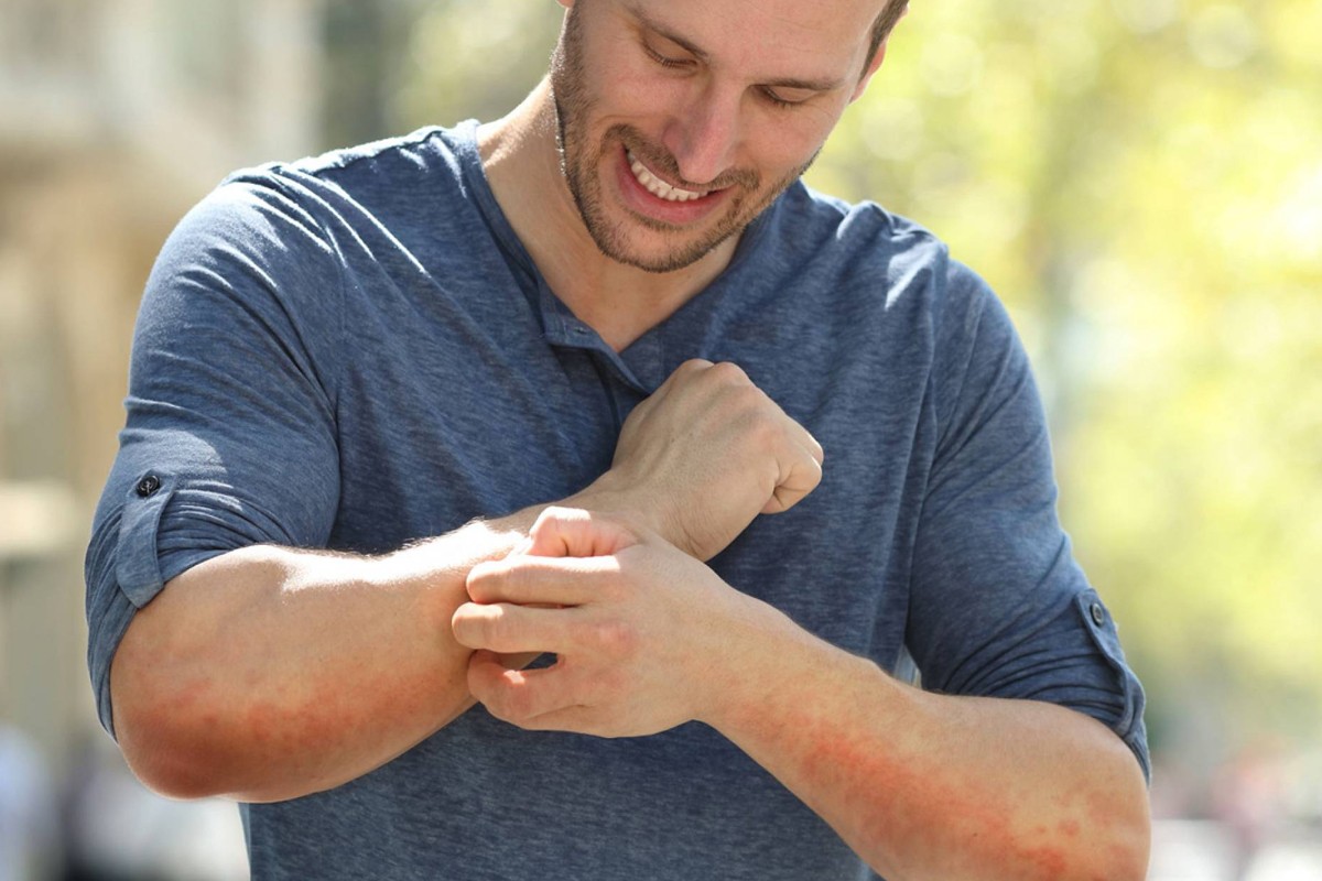 Man scratching an itchy eczema flare on his inner elbow (atopic dermatitis).
