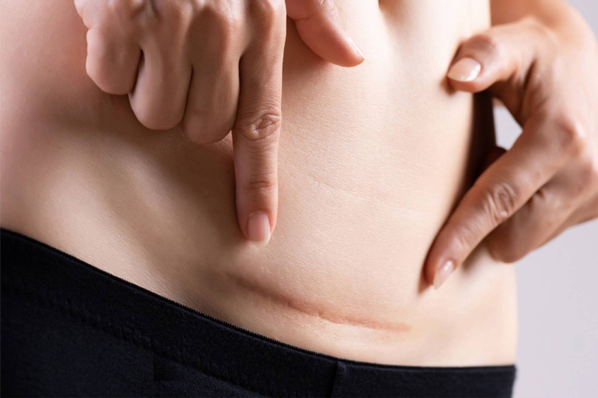 Woman pointing to a healed C-section scar on her lower abdomen (postpartum surgical scar)